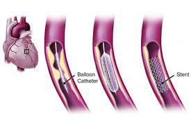 آنژیوگرافی - مطب دکتر آزاده داودیان بروجن