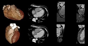 سی تی آنژیو قلب - مطب دکتر آزاده داودیان بروجن